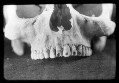 Maxilar superior con perforaciones dentarias, reprografía